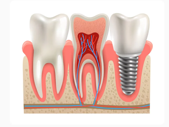 Dental Implant