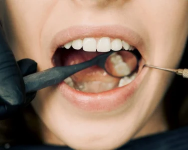 Gum Disease